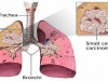 Cancer_pulmonar