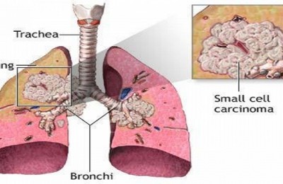 Cancer_pulmonar